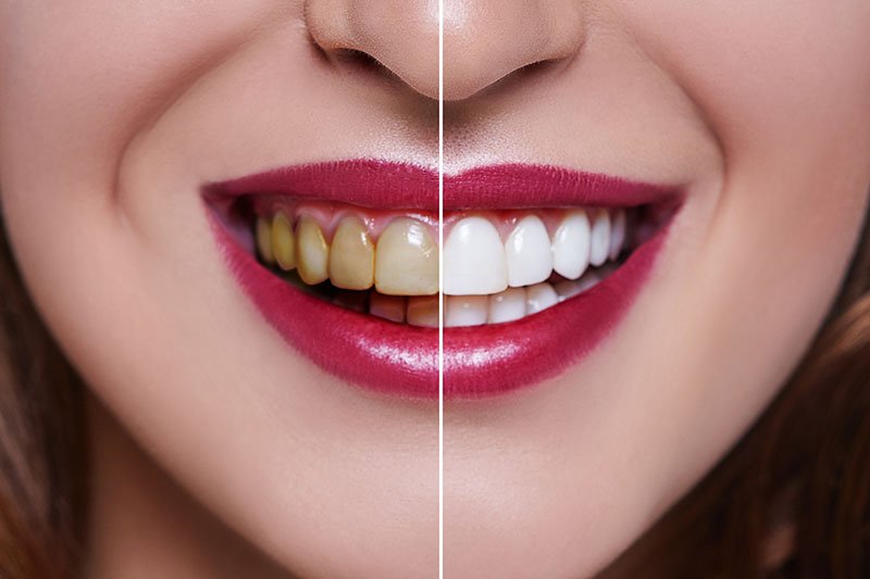 Faccette dentali per un sorriso bello e naturale